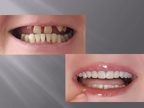 Wurtzel Family Dentistry Before and After Dental Work Photo