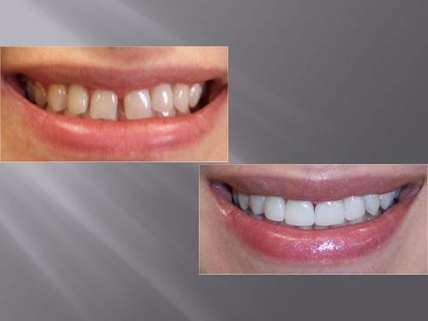 Wurtzel Family Dentistry Before and After Dental Work Photo